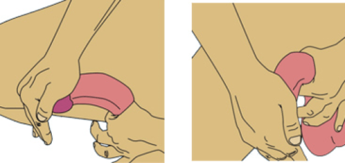 folding the penis for enlargement